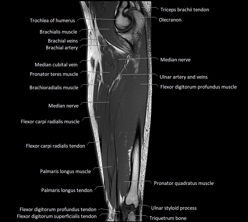 MRI 3T forearm sagittal labelled cross sectional anatomy image 25.webp